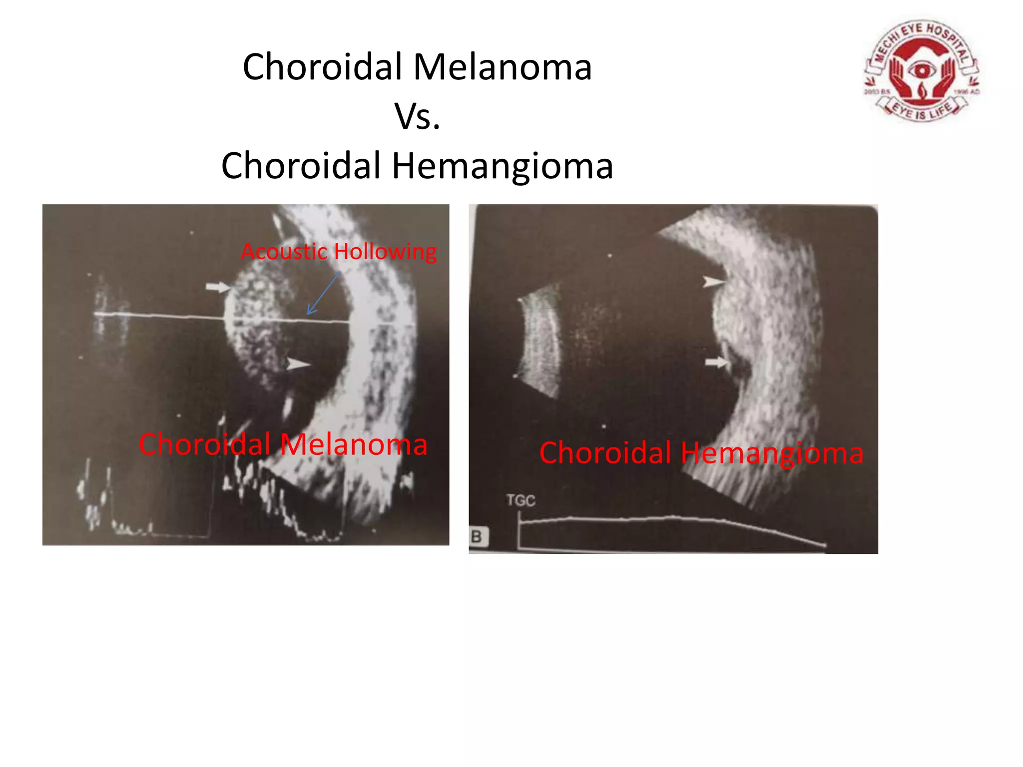 Choroidal Melanoma
Vs.
Choroidal Hemangioma
Acoustic Hollowing
Choroidal Melanoma Choroidal Hemangioma
 