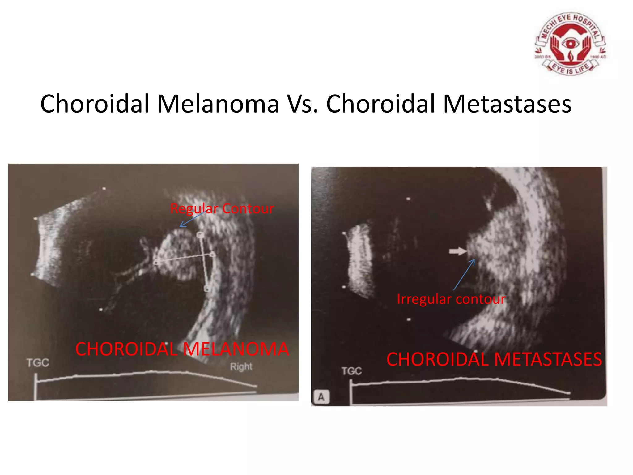 Choroidal Melanoma Vs. Choroidal Metastases
CHOROIDAL MELANOMA CHOROIDAL METASTASES
Regular Contour
Irregular contour
 