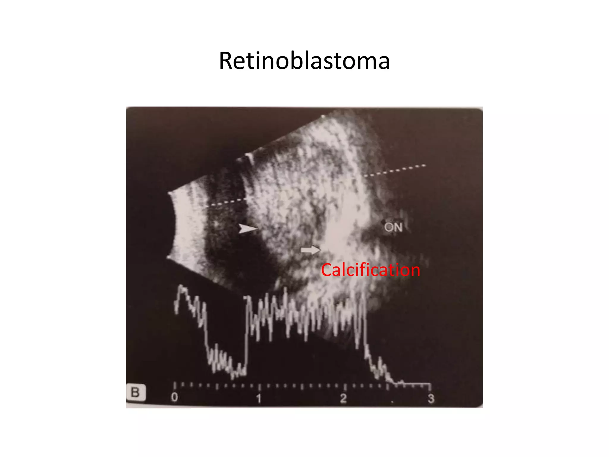 Retinoblastoma
Calcification
 