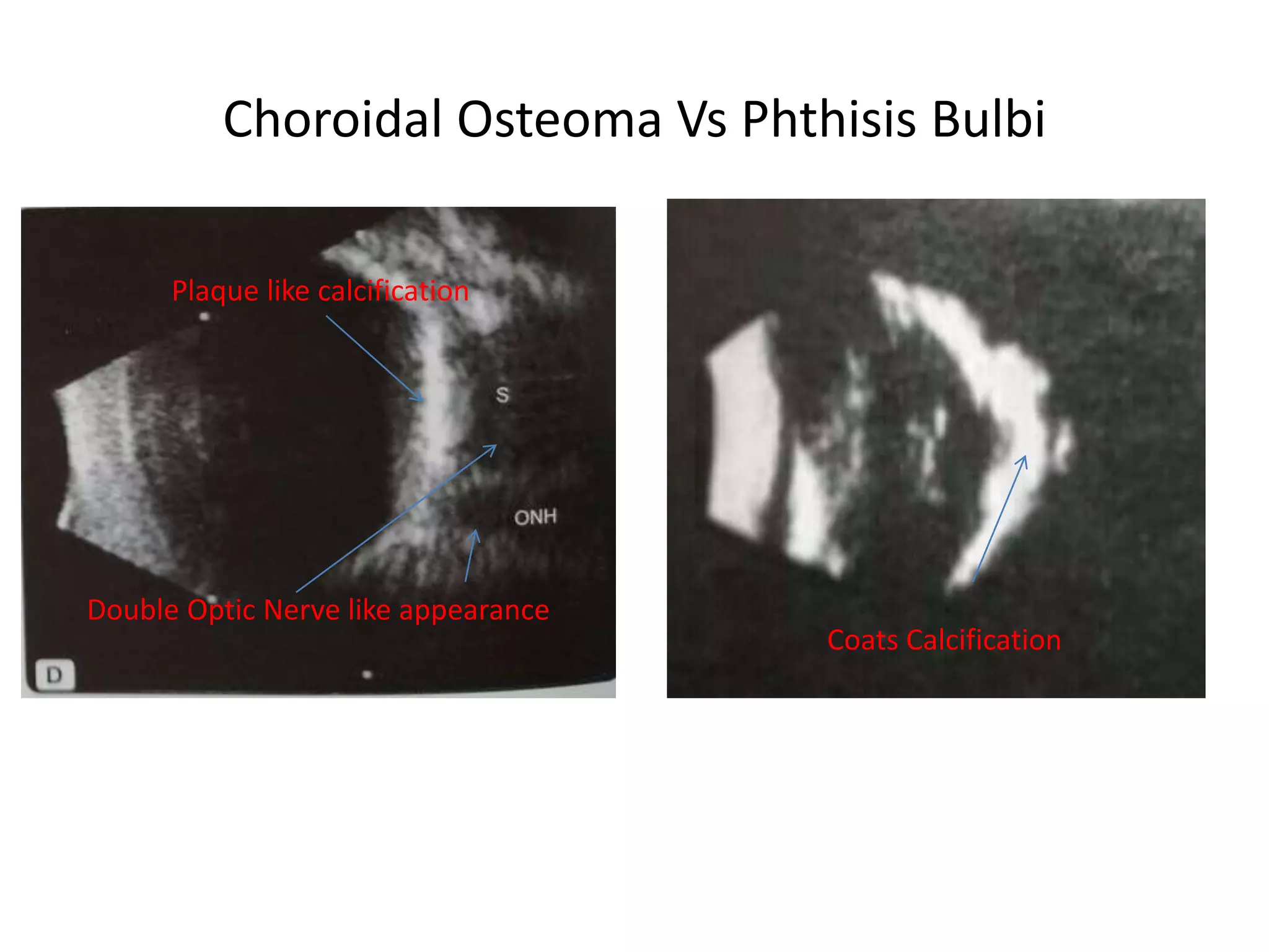 Choroidal Osteoma Vs Phthisis Bulbi
Double Optic Nerve like appearance
Plaque like calcification
Coats Calcification
 