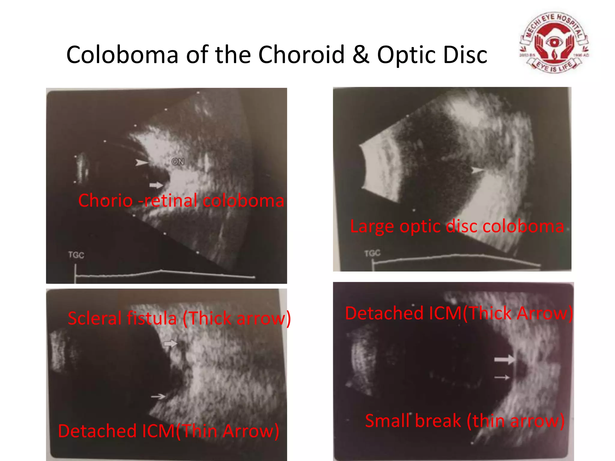 Coloboma of the Choroid & Optic Disc
Detached ICM(Thick Arrow)
Large optic disc coloboma
Chorio -retinal coloboma
Scleral fistula (Thick arrow)
Small break (thin arrow)Detached ICM(Thin Arrow)
 