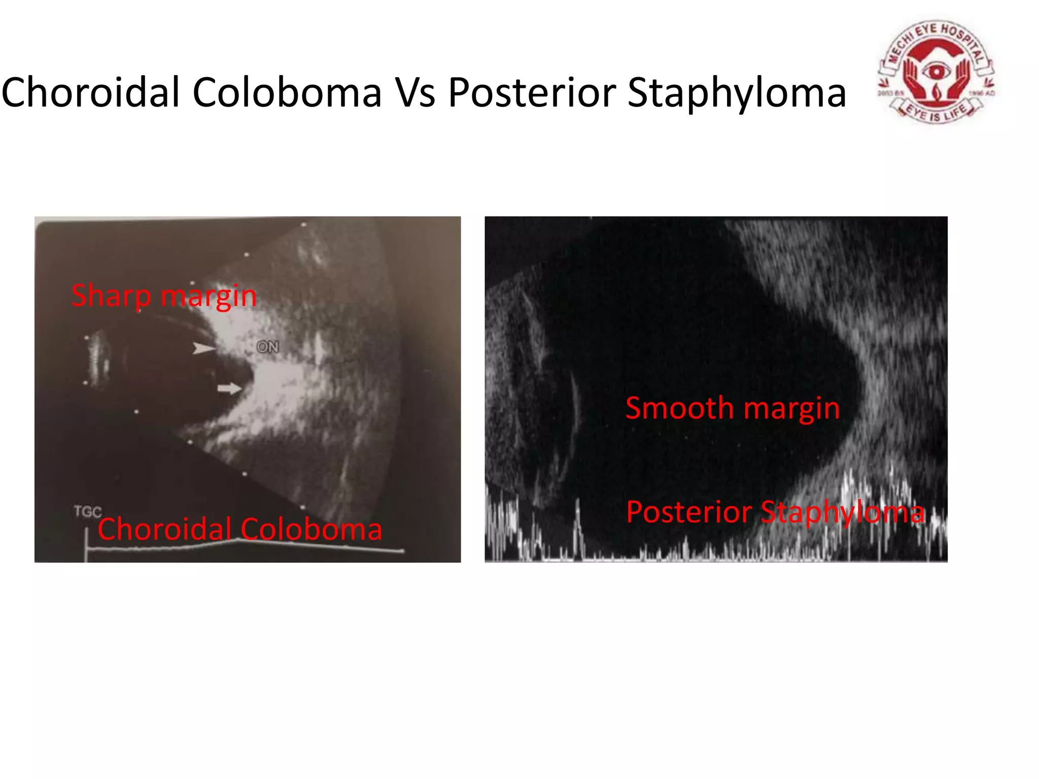 Choroidal Coloboma Vs Posterior Staphyloma
Posterior Staphyloma
Choroidal Coloboma
Smooth margin
Sharp margin
 