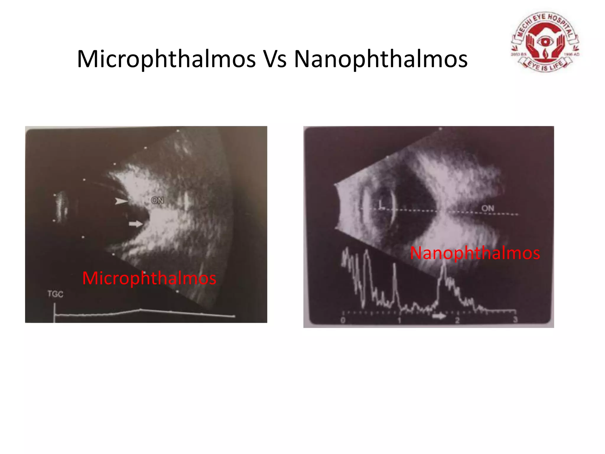 Microphthalmos Vs Nanophthalmos
Microphthalmos
Nanophthalmos
 