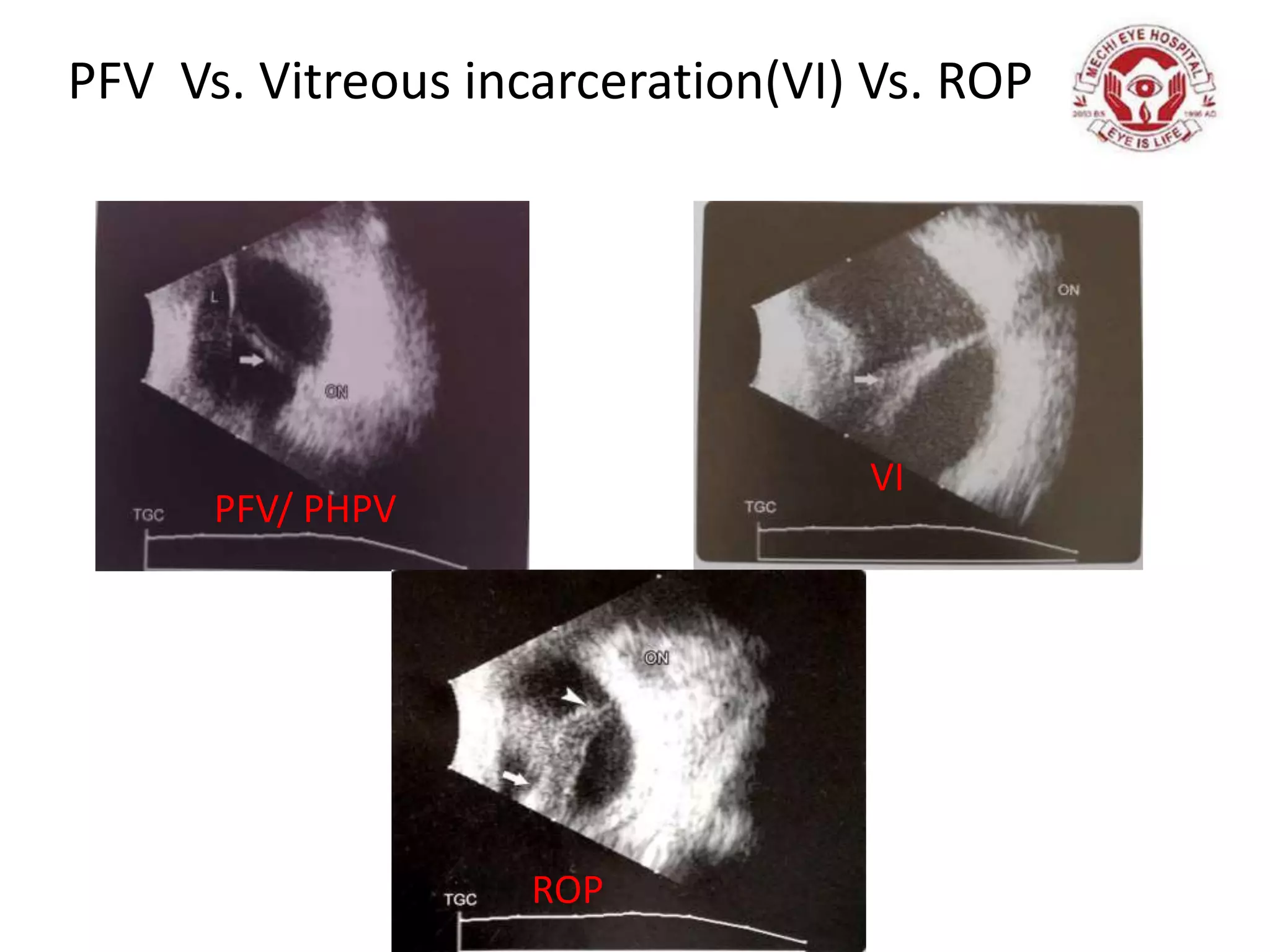 PFV Vs. Vitreous incarceration(VI) Vs. ROP
PFV/ PHPV
ROP
VI
 