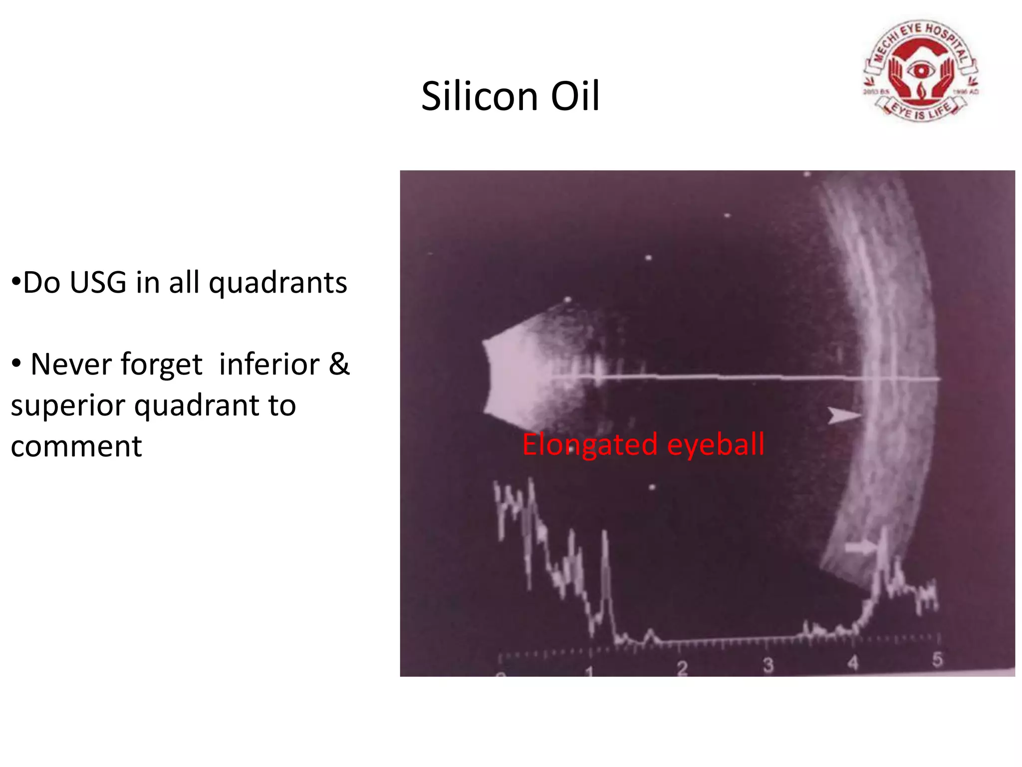 Silicon Oil
Elongated eyeball
•Do USG in all quadrants
• Never forget inferior &
superior quadrant to
comment
 
