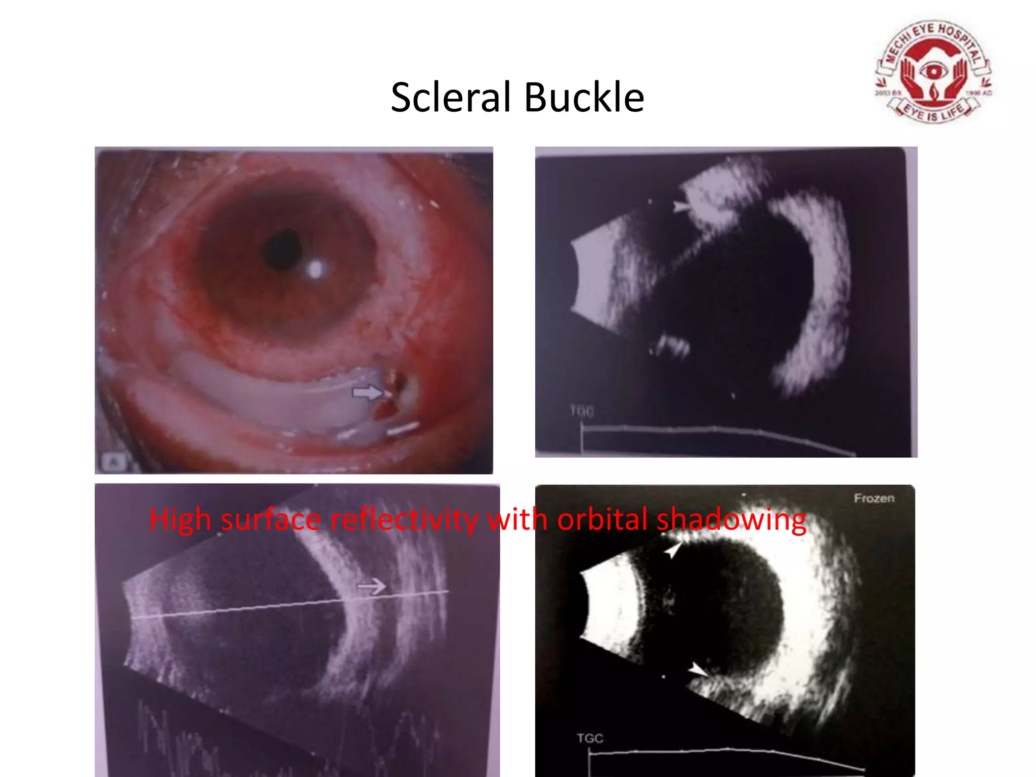 Scleral Buckle
High surface reflectivity with orbital shadowing
 