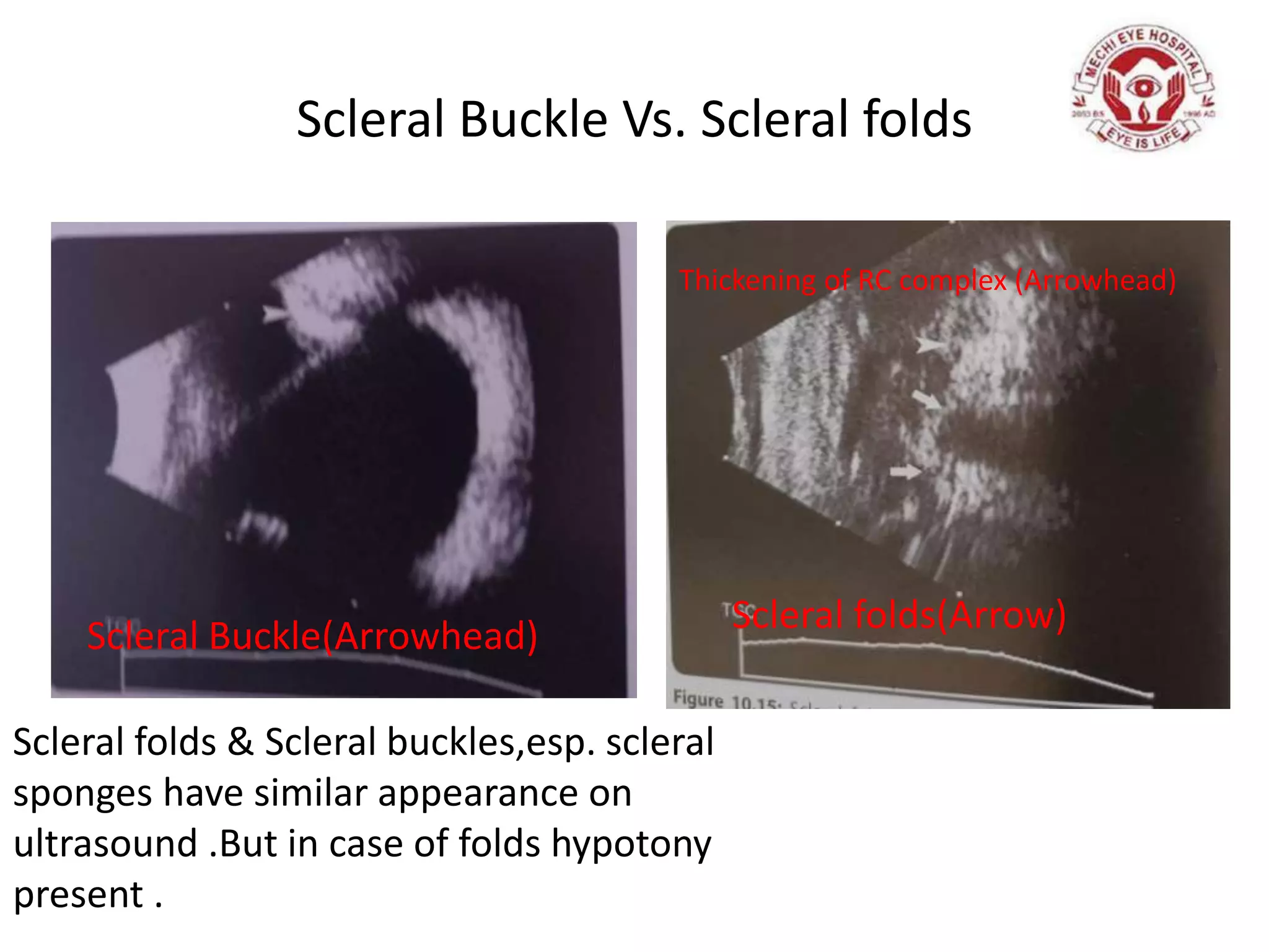 Scleral Buckle Vs. Scleral folds
Thickening of RC complex (Arrowhead)
Scleral folds(Arrow)
Scleral Buckle(Arrowhead)
Scleral folds & Scleral buckles,esp. scleral
sponges have similar appearance on
ultrasound .But in case of folds hypotony
present .
 