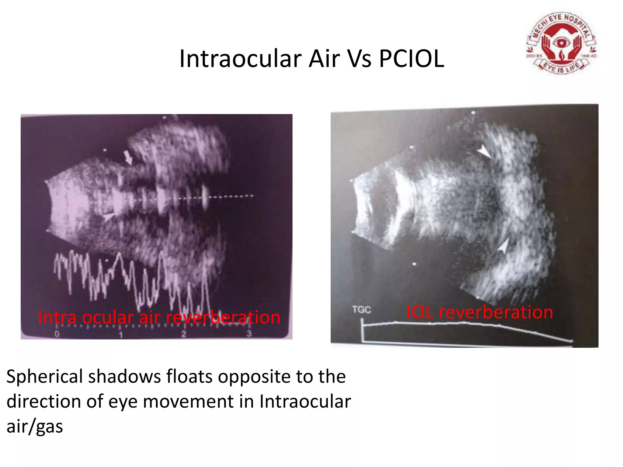 Intraocular Air Vs PCIOL
IOL reverberationIntra ocular air reverberation
Spherical shadows floats opposite to the
direction of eye movement in Intraocular
air/gas
 
