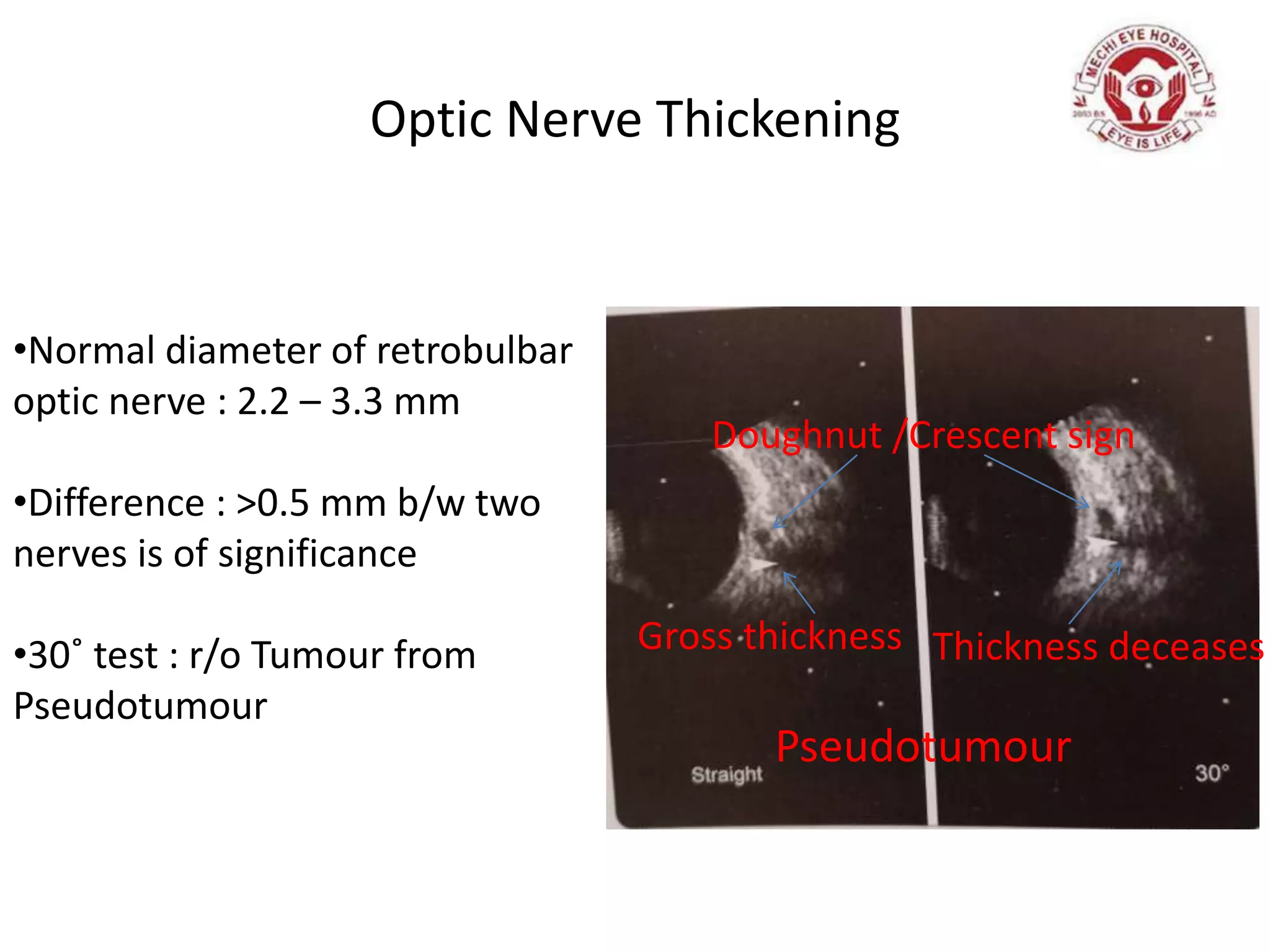 Optic Nerve Thickening
•Normal diameter of retrobulbar
optic nerve : 2.2 – 3.3 mm
•Difference : ˃0.5 mm b/w two
nerves is of significance
•30˚ test : r/o Tumour from
Pseudotumour
Gross thickness Thickness deceases
Pseudotumour
Doughnut /Crescent sign
 