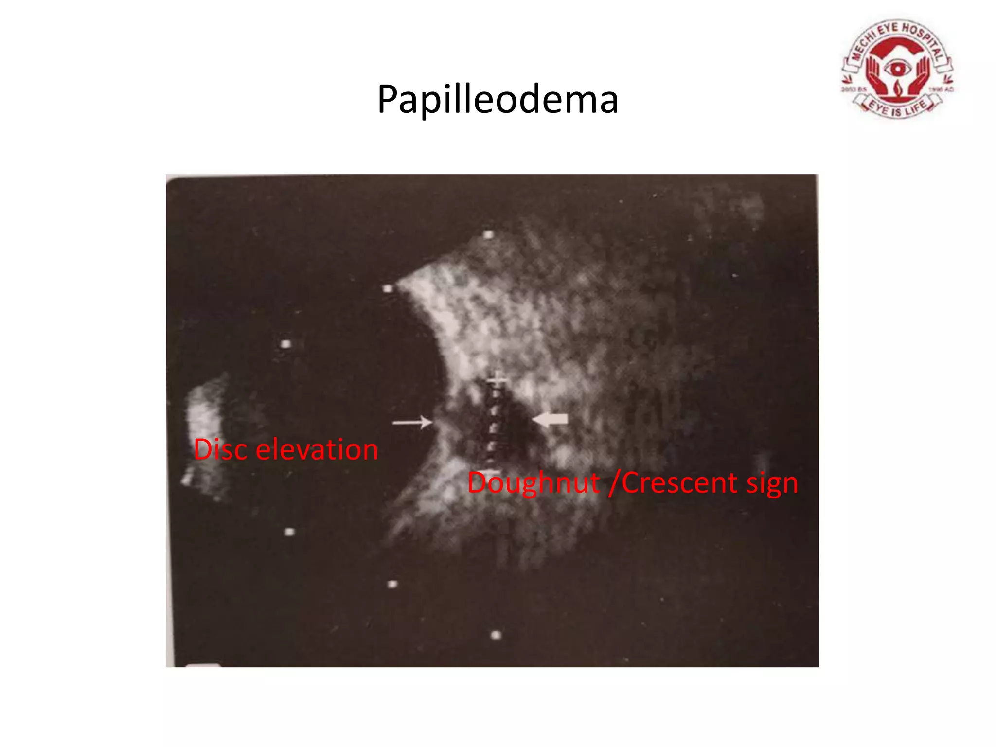 Papilleodema
Doughnut /Crescent sign
Disc elevation
 