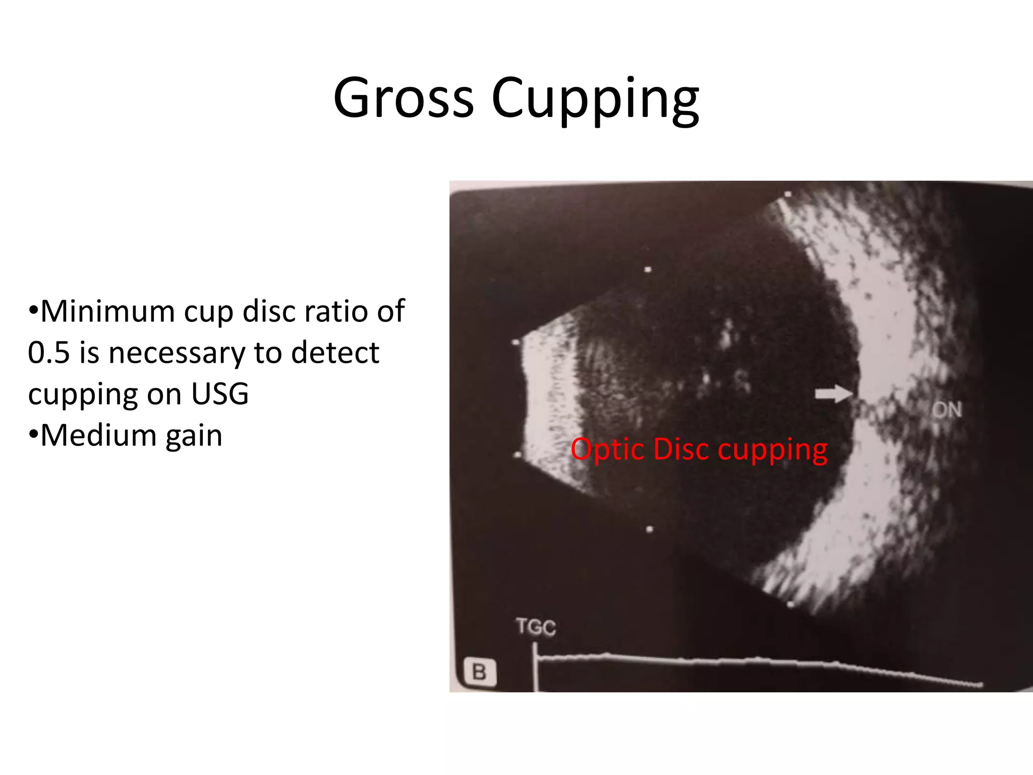 Gross Cupping
Optic Disc cupping
•Minimum cup disc ratio of
0.5 is necessary to detect
cupping on USG
•Medium gain
 