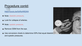 Procedure contd;
https://youtu.be/5oRoiHflGW4
Note: diastolic pressure.
Look for collapse of arteries.
Note: systolic pressure.
Remove ODM from the eye.
Use conversion charts to determine IOPs that equal diastolic
and systolic pressures.
 