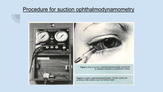 Procedure for suction ophthalmodynamometry
 