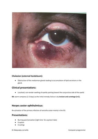 Chalazion (external hordeleum):
● Obstruction of the meibomian glands leading to accumulation of lipid secretions in the
gland.
Clinical presentations:
● Localised, non-tender swelling of eyelids panting toward the conjunctiva side of the eyelid.
RX:​​ warm compress (2-3 days) as the initial remedy.Failure is by ​incision and curettage (I+C).
Herpes zoster ophthalmicus:
Re-activation of the primary infection of varicella zoster mainly in the ISS.
Presentations:
● Burning pain/sensation (right time for acyclovir tabs)
● Eruption
● Crustings
Dr Ndayisaba corneille Computer programmer
 