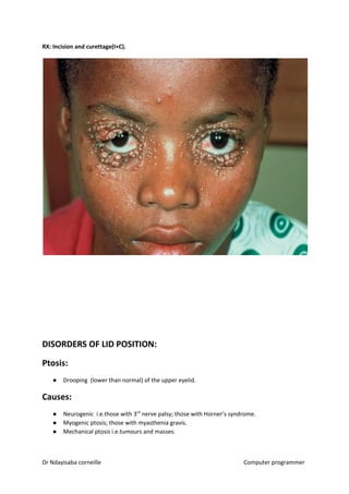 RX: Incision and curettage(I+C).
DISORDERS OF LID POSITION:
Ptosis:
● Drooping (lower than normal) of the upper eyelid.
Causes:
● Neurogenic i.e.those with 3​rd​
nerve palsy; those with Horner’s syndrome.
● Myogenic ptosis; those with myasthenia gravis.
● Mechanical ptosis i.e.tumours and masses.
Dr Ndayisaba corneille Computer programmer
 