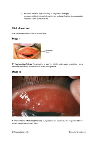 o Recurrent infection leads to scaring of conjunctiva leading to
entropion-trichiasis-corneal ulceration –corneal opacification. Blindness due to
trachoma is only found in adults.
Clinical features:
W.H.O.classified clinical features into 5 stages:
Stage I:
TF- Trachomatous follicles​​. There must be at least five follicles on the upper tarsal plate + some
papillae but the blood vessels must be visible through them.
Stage II:
TI- Trachomatous inflammation intense​​. Many follicles and papillae but the conjunctival blood
vessels are not seen through them.
Dr Ndayisaba corneille Computer programmer
 