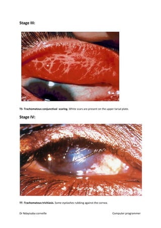 Stage III:
TS- Trachomatous conjunctival scaring.​​ White scars are present on the upper tarsal plate.
Stage IV:
TT- Trachomatous trichiasis.​​ Some eyelashes rubbing against the cornea.
Dr Ndayisaba corneille Computer programmer
 