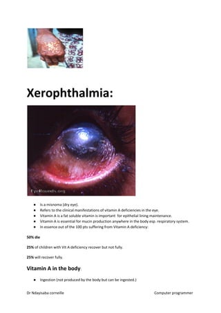 Xerophthalmia:
● Is a misnoma (dry eye).
● Refers to the clinical manifestations of vitamin A deficiencies in the eye.
● Vitamin A is a fat soluble vitamin is important for epithelial lining maintenance.
● Vitamin A is essential for mucin production anywhere in the body esp. respiratory system.
● In essence out of the 100 pts suffering from Vitamin A deficiency:
50% die
25%​​ of children with Vit A deficiency recover but not fully.
25%​​ will recover fully.
Vitamin A in the body​​:
● Ingestion (not produced by the body but can be ingested.)
Dr Ndayisaba corneille Computer programmer
 