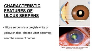 Ulcus Rodems Ophthalmology bacterial ulver seminar bacterial ulcer ulcer ulcer | PPTX