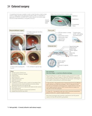 Eye Distance Surgery Ophthalmology at a Glance.pdf