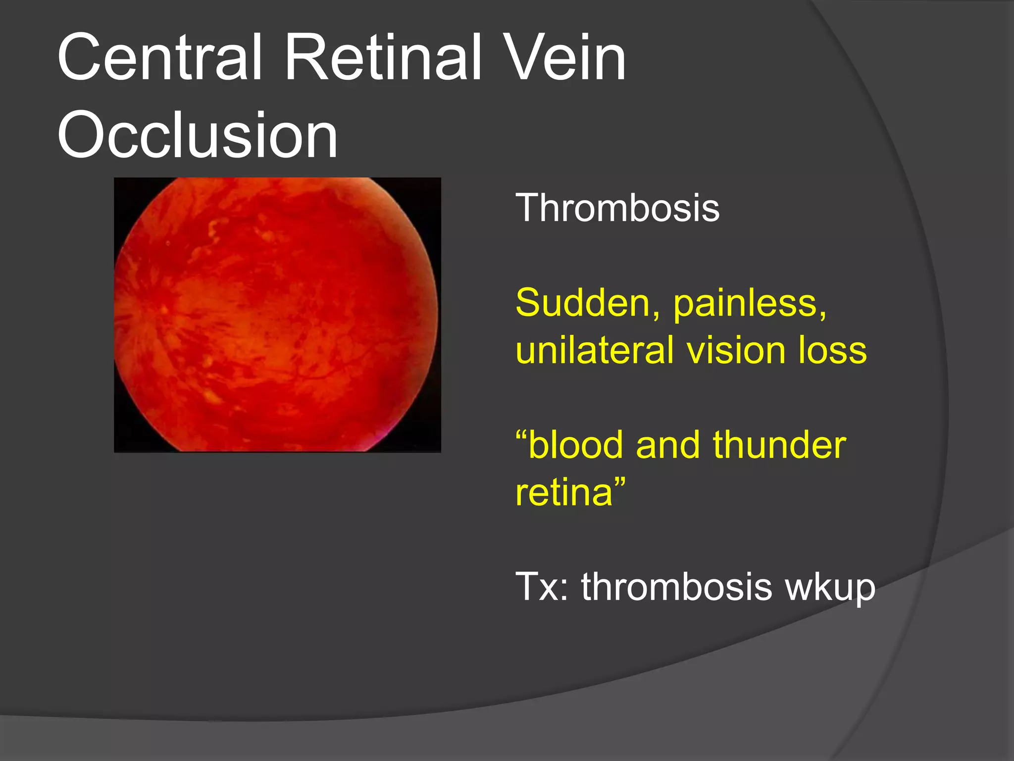 Dvt Vision Ophthalmology Board Review- Emergency Medicine 2014 | PPTX