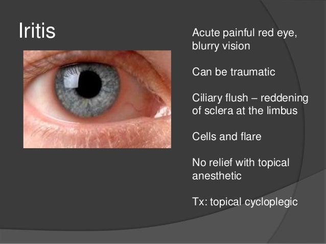 What is iritis of the eye?