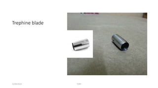 Trephine blade 
11/09/2014 TONY 
 