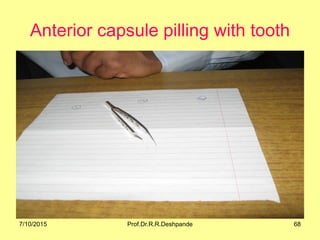 Anterior capsule pilling with tooth
7/10/2015 68Prof.Dr.R.R.Deshpande
 