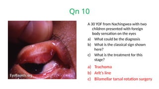 Qn 10
A 30 YOF from Nachingwea with two
children presented with foreign
body sensation on the eyes
a) What could be the diagnosis
b) What is the classical sign shown
here?
c) What is the treatment for this
stage?
a) Trachoma
b) Arlt’s line
c) Bilamellar tarsal rotation surgery
 