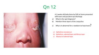 Qn 12
A 2 weeks old baby bone by SVD at home presented
with tears and purulent eye discharge
a) What is the spot diagnosis?
b) Mention three layers of the conjuctiva
c) Why is it abnormal for a newborn to have tears?
a) Opthalmia neonatorum
b) Epithelium, adenoid layer and fibrous layer
c) Absence of adenoid layer
 