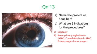 Qn 13
a) Name the procedure
done here
b) What are 3 indications
for the procedures?
a) Iridotomy
b) Acute primary angle closure
(APAC), Contralateral eye in APAC,
Primary angle closure suspect
 