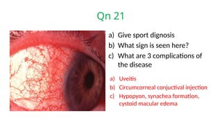 Qn 21
a) Give sport dignosis
b) What sign is seen here?
c) What are 3 complications of
the disease
a) Uveitis
b) Circumcorneal conjuctival injection
c) Hypopyon, synachea formation,
cystoid macular edema
 