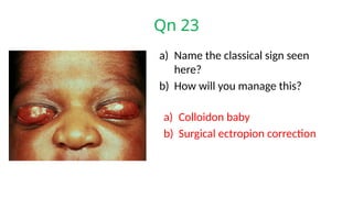 Qn 23
a) Name the classical sign seen
here?
b) How will you manage this?
a) Colloidon baby
b) Surgical ectropion correction
 
