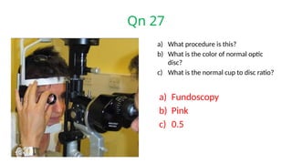 Qn 27
a) What procedure is this?
b) What is the color of normal optic
disc?
c) What is the normal cup to disc ratio?
a) Fundoscopy
b) Pink
c) 0.5
 