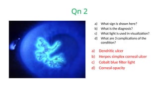 Qn 2
a) What sign is shown here?
b) What is the diagnosis?
c) What light is used in visualization?
d) What are 3 complications of the
condition?
a) Dendritic ulcer
b) Herpes simplex corneal ulcer
c) Cobalt blue filter light
d) Corneal opacity
 