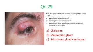 Qn 29
A 29 YOM presented with painless swelling on his upper
lid.
a) What is the spot diagnosis?
b) Which gland is involved here?
c) What is the differential diagnosis if it frequently
recurs after resection?
a) Chalazion
b) Meibomian gland
c) Sebaceous gland carcinoma
 