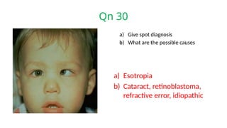 Qn 30
a) Give spot diagnosis
b) What are the possible causes
a) Esotropia
b) Cataract, retinoblastoma,
refractive error, idiopathic
 