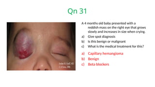 Qn 31
A 4 months old baby presented with a
reddish mass on the right eye that grows
slowly and increases in size when crying.
a) Give spot diagnosis
b) Is this benign or malignant
c) What is the medical treatment for this?
a) Capillary hemangioma
b) Benign
c) Beta blockers
 