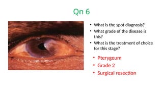 Qn 6
• What is the spot diagnosis?
• What grade of the disease is
this?
• What is the treatment of choice
for this stage?
• Pterygeum
• Grade 2
• Surgical resection
 