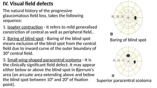 Contraction Visual Field Ophthalmology Seminar final topic open angle glaucoma | PPTX