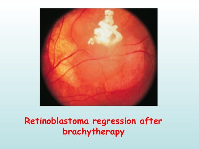 Cherry Red Spot Ground Glass Retina Cherry Red Spot Ground Glass Retina