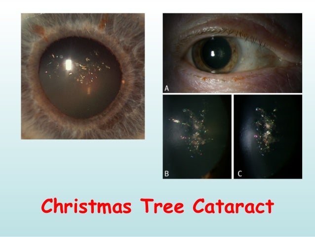 ophthalmology signs around us christmas syndrome