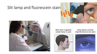 Slit lamp and fluorescein staining
 