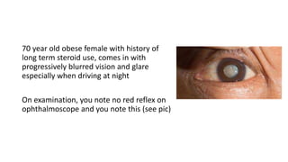70 year old obese female with history of
long term steroid use, comes in with
progressively blurred vision and glare
especially when driving at night
On examination, you note no red reflex on
ophthalmoscope and you note this (see pic)
 