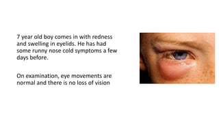 7 year old boy comes in with redness
and swelling in eyelids. He has had
some runny nose cold symptoms a few
days before.
On examination, eye movements are
normal and there is no loss of vision
 