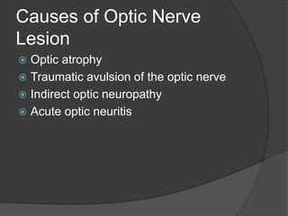 Causes of Optic Nerve
Lesion
 Optic atrophy
 Traumatic avulsion of the optic nerve
 Indirect optic neuropathy
 Acute optic neuritis
 