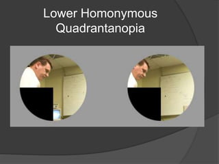 Lower Homonymous
Quadrantanopia
 