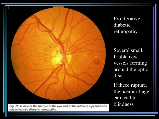 Diabetic Retinopathy Wikipedia