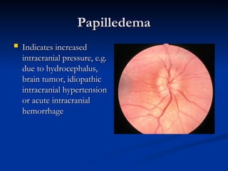 Papilledema
Papilledema
 Indicates increased
Indicates increased
intracranial pressure, e.g.
intracranial pressure, e.g.
due to hydrocephalus,
due to hydrocephalus,
brain tumor, idiopathic
brain tumor, idiopathic
intracranial hypertension
intracranial hypertension
or acute intracranial
or acute intracranial
hemorrhage
hemorrhage
 