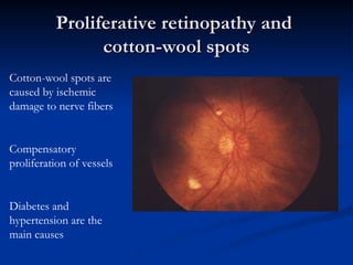 Proliferative retinopathy and
Proliferative retinopathy and
cotton-wool spots
cotton-wool spots
Cotton-wool spots are
caused by ischemic
damage to nerve fibers
Compensatory
proliferation of vessels
Diabetes and
hypertension are the
main causes
 